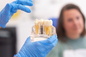 Impianti dentali a Conversano
