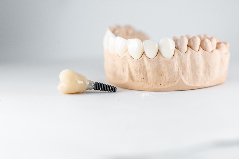 Mantenimento impianti dentali