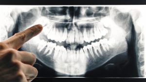rimandare la sostituzione dei denti mancanti